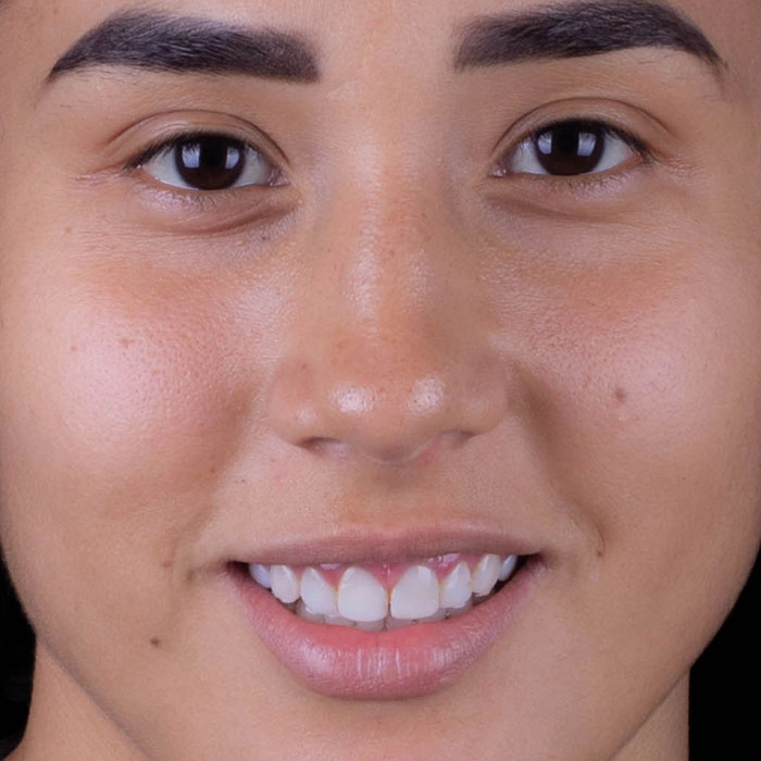 Recorte de encía después - Brenda