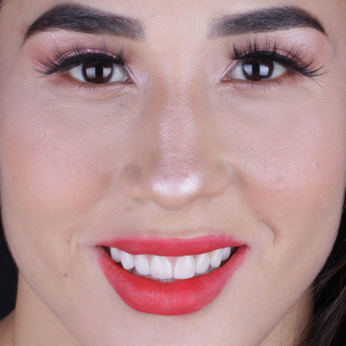 Recorte de encía antes - Brenda