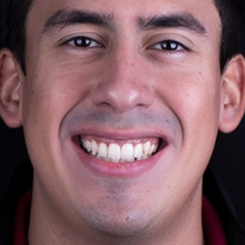 Recorte de encía antes - Marcelo